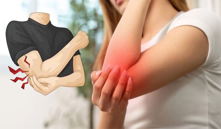 Dirsekte Uyuşma ve Karıncalanmanın Gizli Nedeni: Kubital Tünel Sendromu